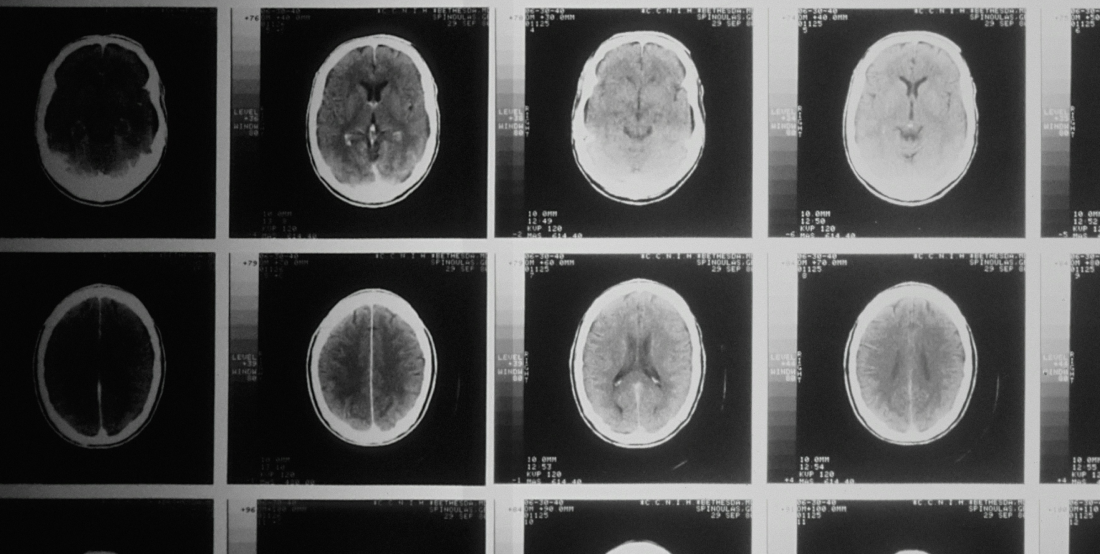 Brain Scan Medical Claim